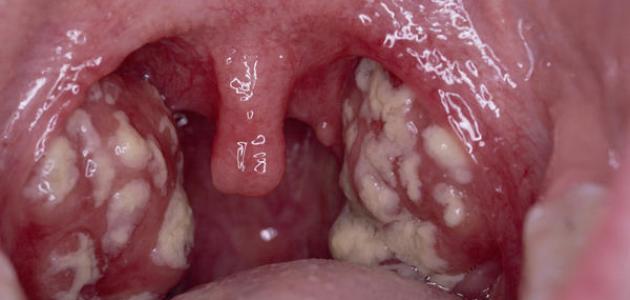 علاج التهاب اللوزتين , التهاب اللوز واسبابة وعلاجة