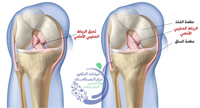 عملية الرباط الصليبي , ماهي عملية الرباط الصليبي