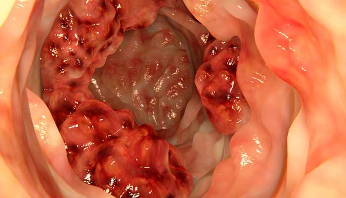 اعراض سرطان القولون , كيف اعرف اني مصاب بسرطان القولون