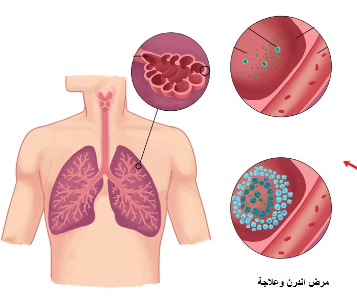 مرض الدرن , ماهى اعراض مرض الدرن