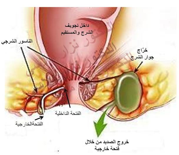 ما هو الناسور , ماهى اعراض الناسور