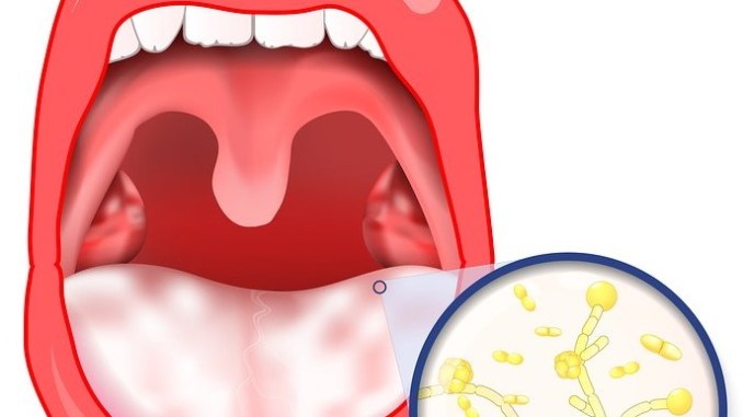 طرق علاج فطريات اللسان , تعرف على اسباب وعلاج فطريات اللسان