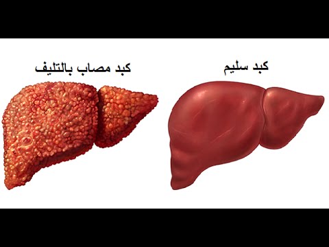 علاج تليف الكبد , معلومات عن مرض تليف الكبد