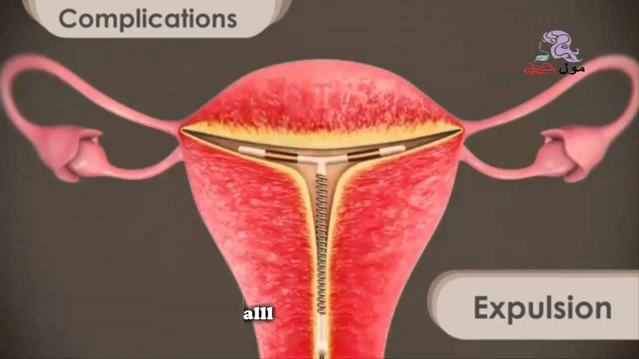 اضرار اللولب , اضرار موانع الحمل المختلفه