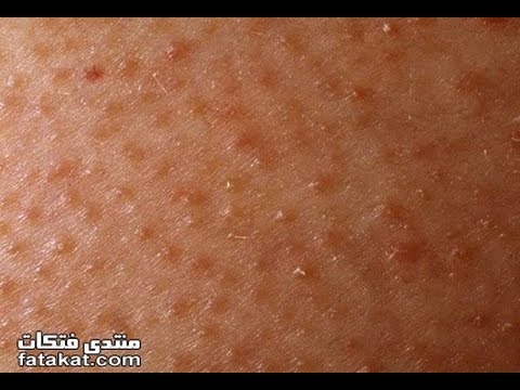 حبوب في المؤخرة , ضرورة اللجوء للطبيب فى تلك الحالة 