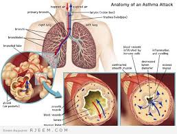 علاج الربو - علاج مرض الربو
