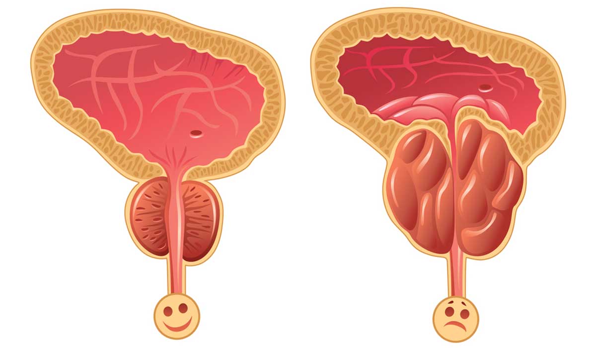 اسباب تضخم البروستاتا , ماهى العوامل التى تؤدى الى التهاب البروستاتا