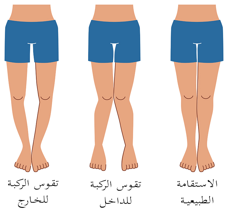 مرض الكساح , علاج لين العظام في الاطفال يقيهم من مشاكله في الكبر