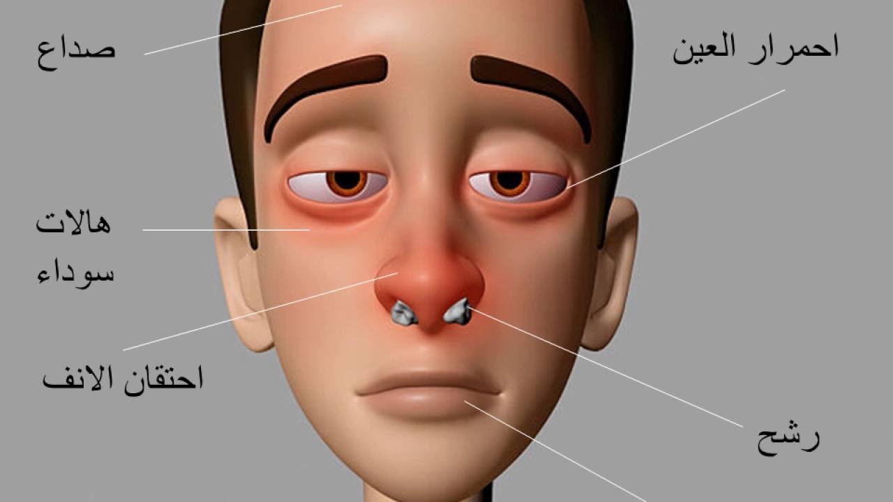 علاج حساسية الانف , طرق للتعافى من الجيوب الانفيه