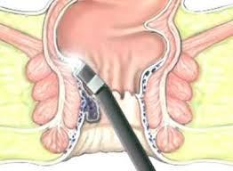 علاج البواسير بالليزر , كل ما تريد معرفته عن معالجة البواسير بالليزر