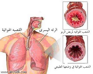 ماهو مرض الدرن