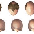 5256 3 علاج تساقط الشعر - علاجات تساقط الشعر الولد المصلح