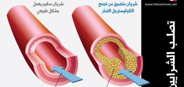 نسبة الكولسترول الطبيعي , معدل نسبه الكوليسترول فى الجسم